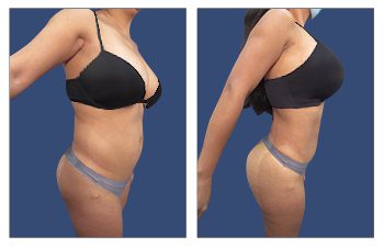 Mini Tummy Tuck