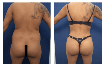 buttock augmentation patient 1 back view