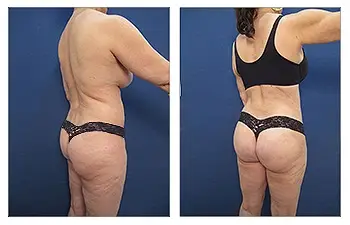 Brazilian Buttock Lift San Diego