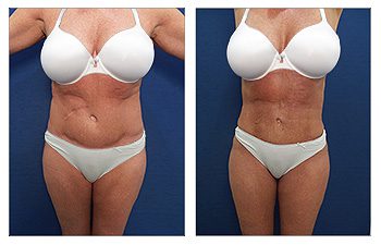 Eliminating Upper Abdominal Skin Rolls with Tummy Tuck