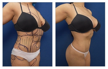 Vaser Lipo Newport Beach