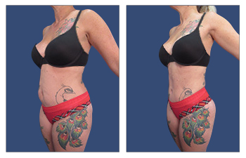 Laguna Beach Plastic surgery Tummy tuck before and after.