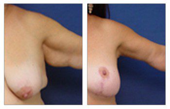 brachioplasty surgery left arm view