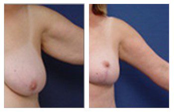 High Definition Arm Contouring, ARM LIFT SURGERY