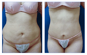 Mini Tummy Tuck vs Full Tummy Tuck