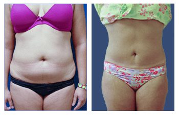 Mini Tummy Tuck Reviews