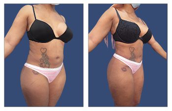 Before and after pictures of a woman's Mini Tummy Tuck After C Section.