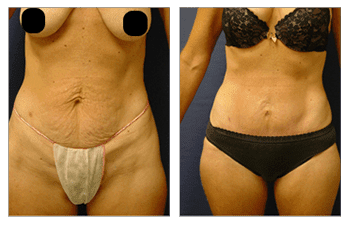 mini tummy tuck patient 7 before and after