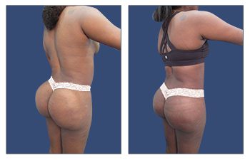 Proper Buttock Implant Placement