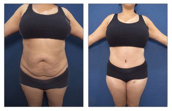 What Is The Cause Of Lipedema?