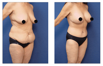 What is The Difference Between Lipedema and Lymphedema?