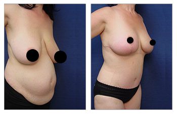 Breast Lift Procedure