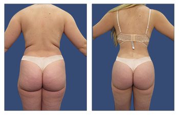 Witness the transformation of a woman's butt in Beverly Hills, before and after liposuction.