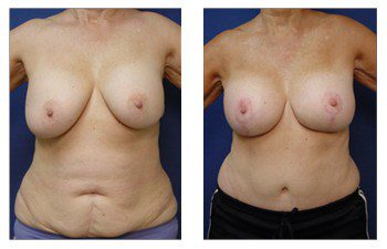 breast augmentation revision patient 1 front view