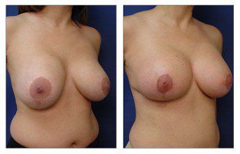 breast augmentation smaller patient 16 front right view