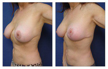 breast augmentation revision recovery patient 9 front left view