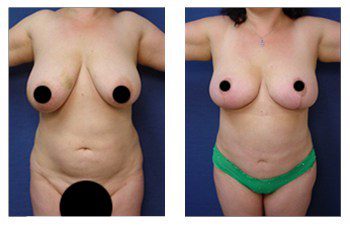 Cheapest Breast Lift