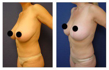 Breast Lift Risks