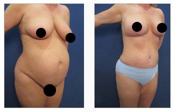 Types of Breast Lifts