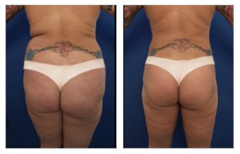 Ideal Treatment Of Lipedema