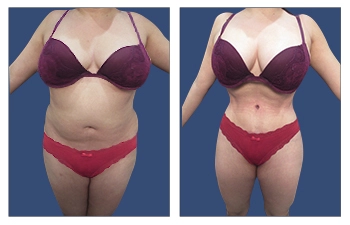 Do I Need Lymphatic Message After Vaser Liposuction