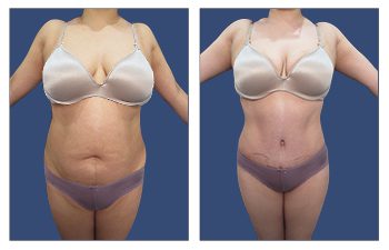 Tummy Tuck 22 BGOK