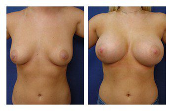 Breast Augmentation to Go Bigger, CPSI.