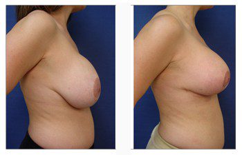 breast augmentation revision patient 16 right view