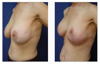 breast lift and augmentation patient 19 front left view