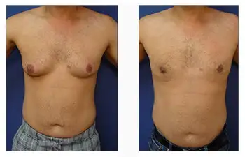 Gynecomastia Surgery Cost