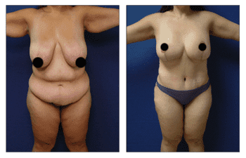 Plastic Surgery before and after Tummy Tuck.