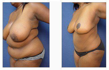 post bariatric surgery patient 16 front left