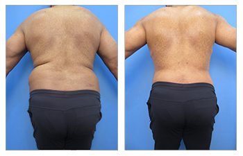 Male Back Liposuction