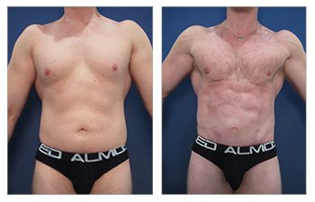 Tummy tuck before and after for the best way to get a square chest.