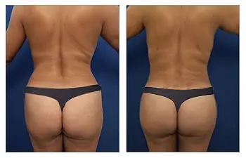 Brazilian Butt Lift Revision Recovery