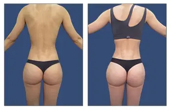 A woman's butt before and after liposuction with a free bbl transformation