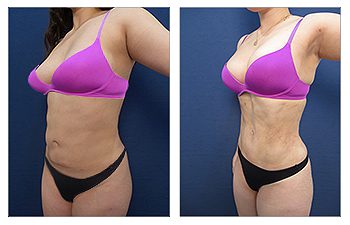 High Definition Mini Tummy Tuck before and after.