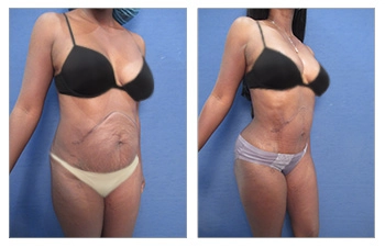 Liposuction Recovery