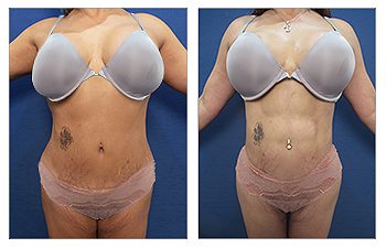 Tummy tuck with VASER lipo before and after.