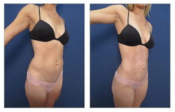 Tummy tuck before and after, also known as liposuction meaning.