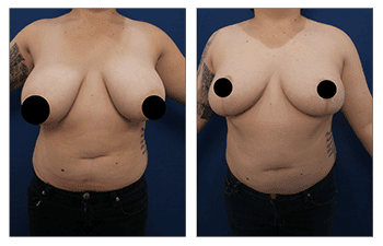 Breast Lift Surgery