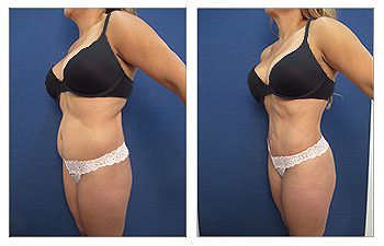 Abdominoplastia - Vegas Liposuction