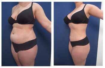 A woman in a bikini before and after liposuction, addressing the lower abdominal bulge issue.