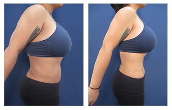 Beware of Yelp - Tummy tuck before and after.