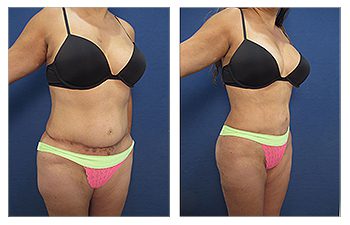 Tummy Tuck Redo 4