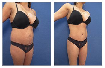 A woman showcasing best liposuction results in a bikini.