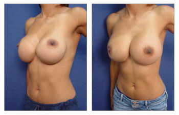 Breast Augmentation Surgery