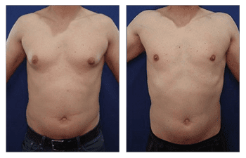 Gynecomastia