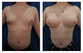 Transgender Breast Surgery