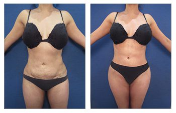 Tummy tuck before and after with painless lipo.